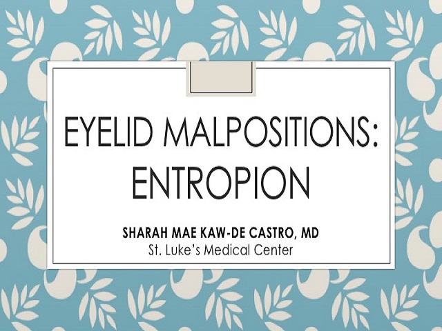 Eyelid: Malpositions: Entropion